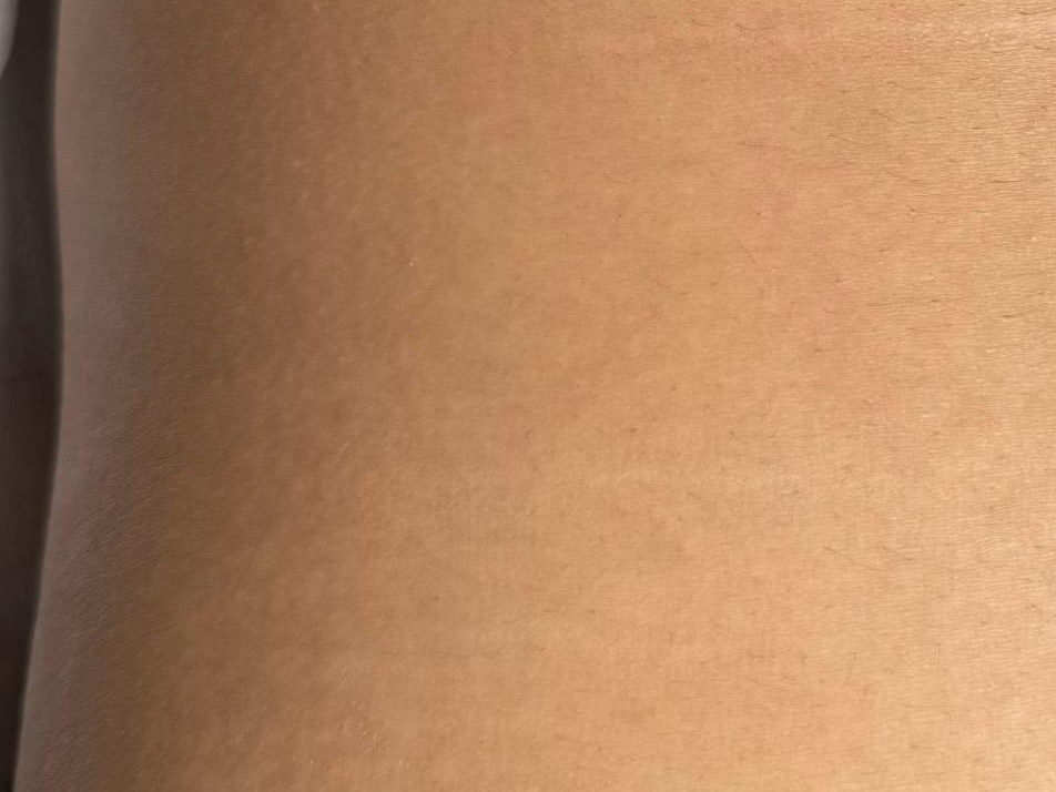 Kere külg, teine vaade — pärast